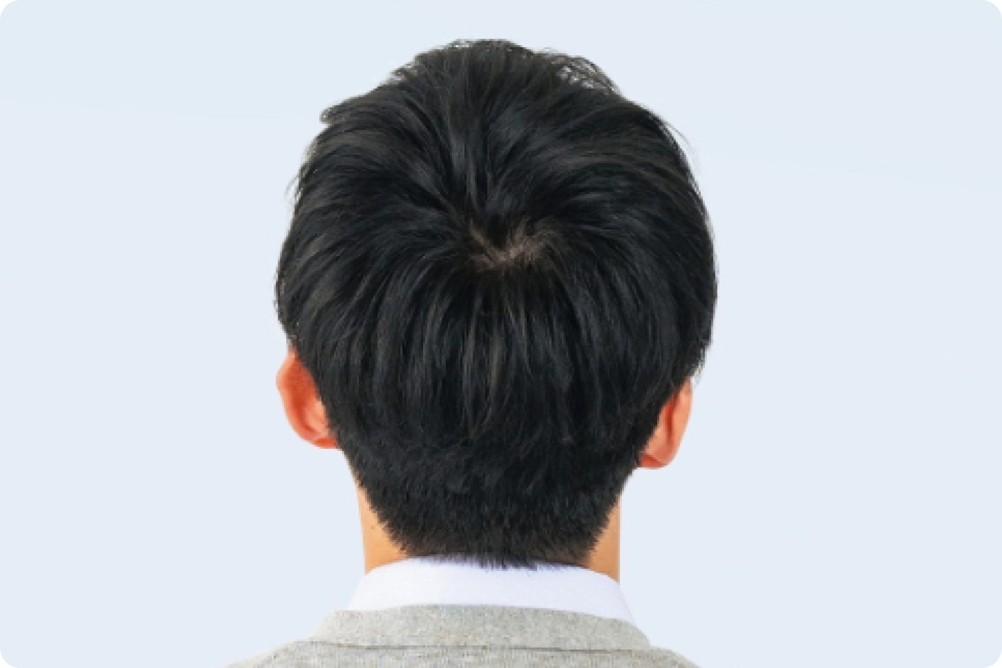 後頭部の髪はそのまま！刈らない自毛植毛