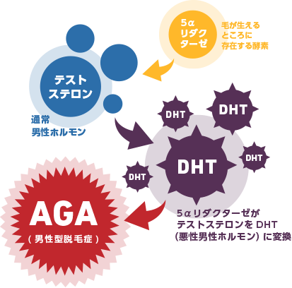AGA発症のメカニズムの図