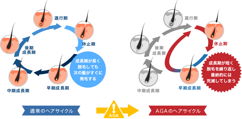 AGAの影響によるヘアサイクルの変化図