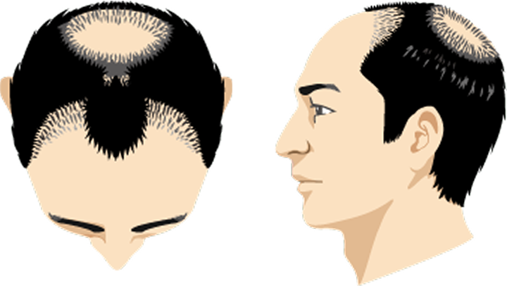 前頭部・頭頂部への施術