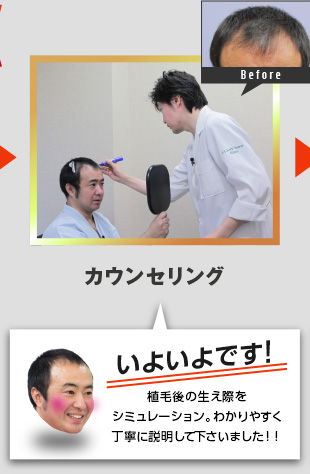 カウンセリング。植毛後の生え際をシミュレーション。わかりやすく丁寧に説明して下さいました！！