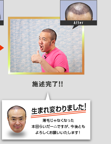 施術完了！（２月公開）薄毛じゃなくなった本田らいだー△ですが、今後ともよろしくお願いいたします！