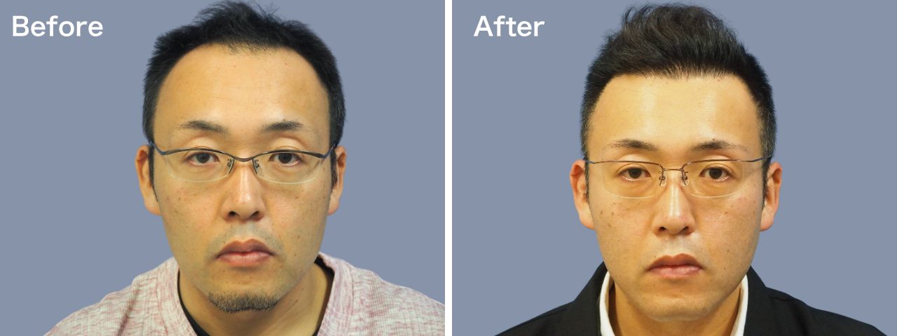 生え際-30代-3000株～-男性-刈り上げる自毛植毛i-Direct