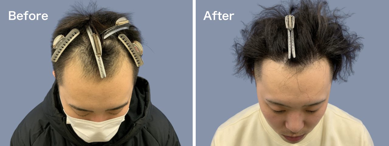前頭部M字-20代-1000～2000株-男性-刈り上げる自毛植毛i-Direct
