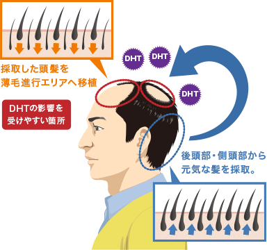 自分の毛髪を薄毛部分に植え付ける施術