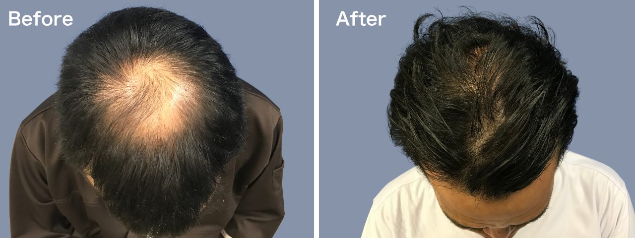 頭頂部-40代-2000～3000株-男性-刈り上げる自毛植毛i-Direct