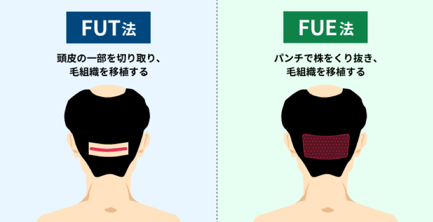 FUT法と、FUE法