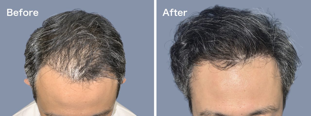 前頭部他院修正-40代-1000～2000株-男性-刈り上げる自毛植毛i-Direct