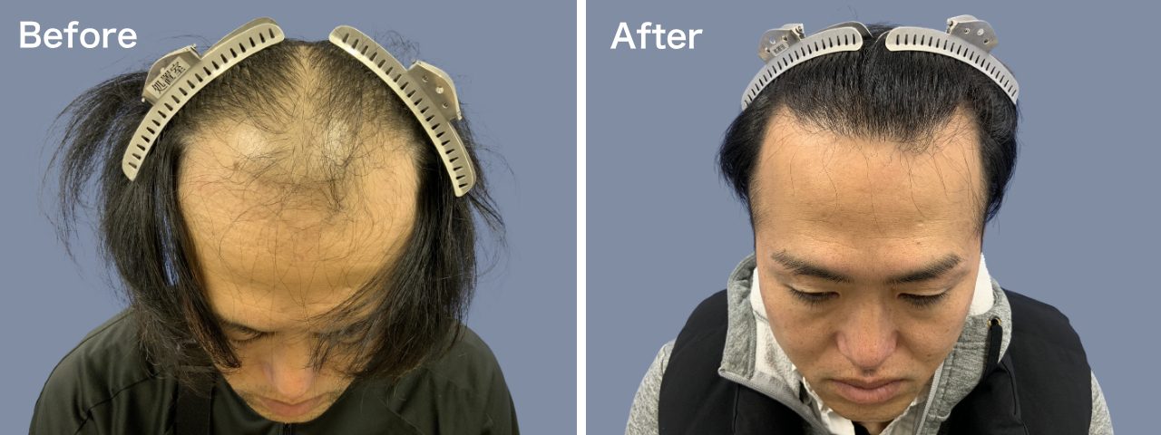 前頭部-30代-2000～3000株-男性-刈り上げる自毛植毛i-Direct