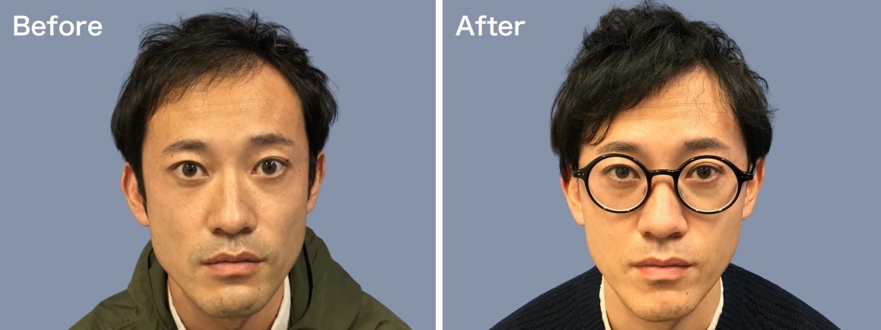 生え際頭頂部前頭部-30代-3000株～-男性-刈り上げる自毛植毛i-Direct