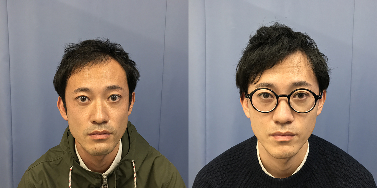 生え際頭頂部前頭部-30代-3000株～-男性-刈り上げる自毛植毛i-Direct