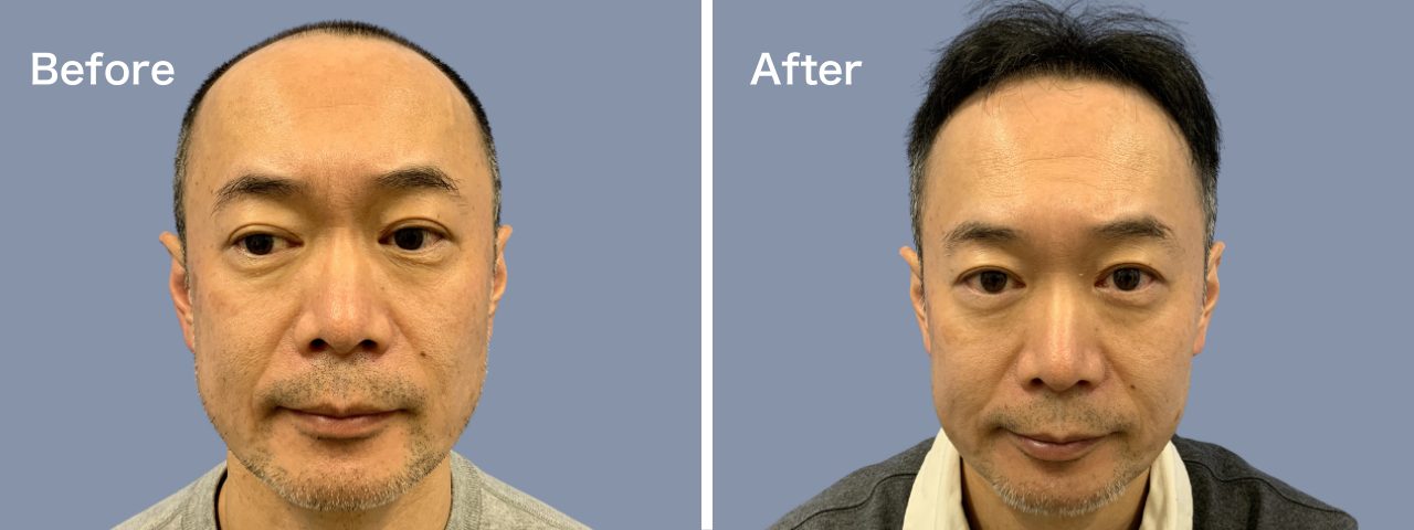 頭頂部前頭部-50代-3000株～-男性-刈り上げる自毛植毛i-Direct