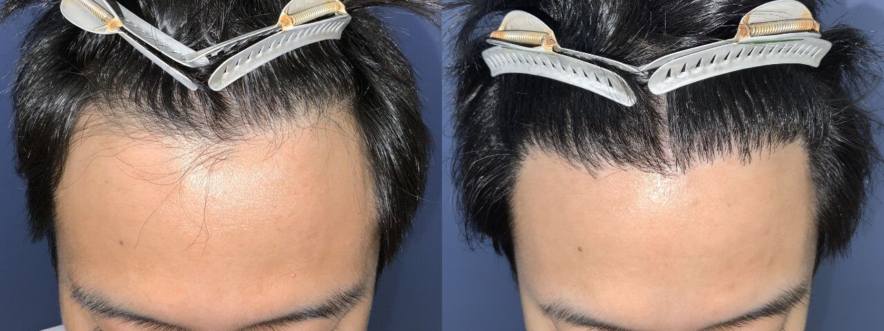 生え際M字-20代-1000～2000株-男性-刈り上げる自毛植毛i-Direct