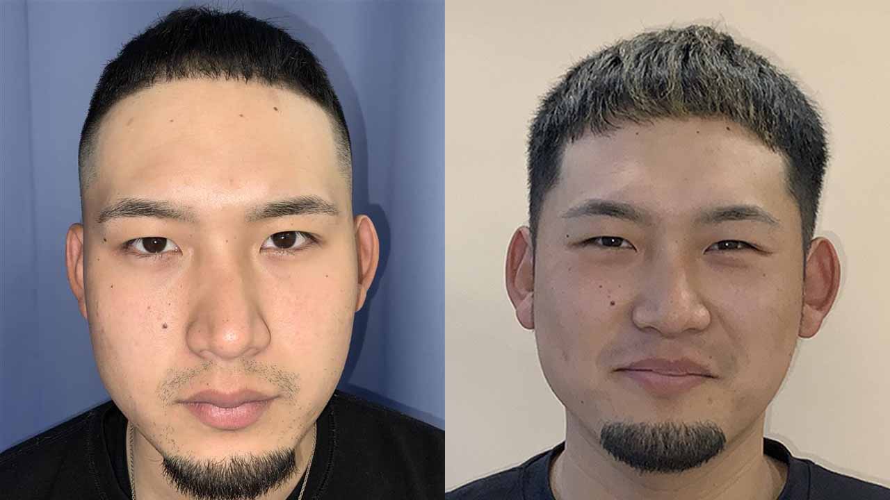 生え際-20代-1000～2000株-刈り上げる自毛植毛i-Direct