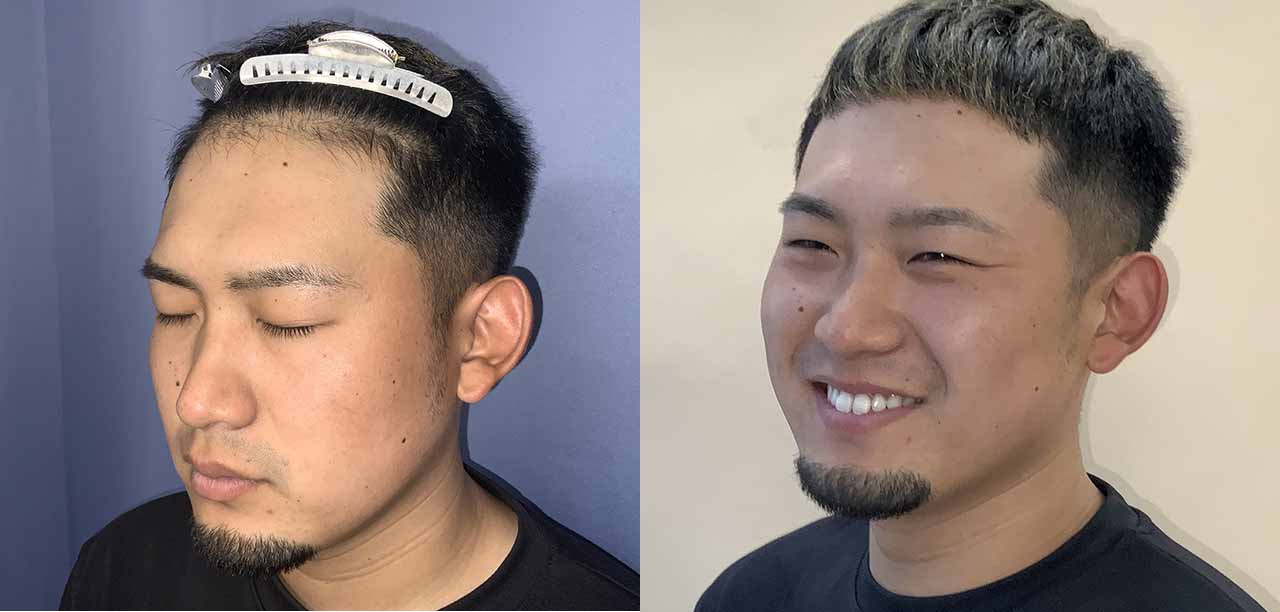 【名古屋院/20代/男性/i-Direct /1600G/生え際】-3