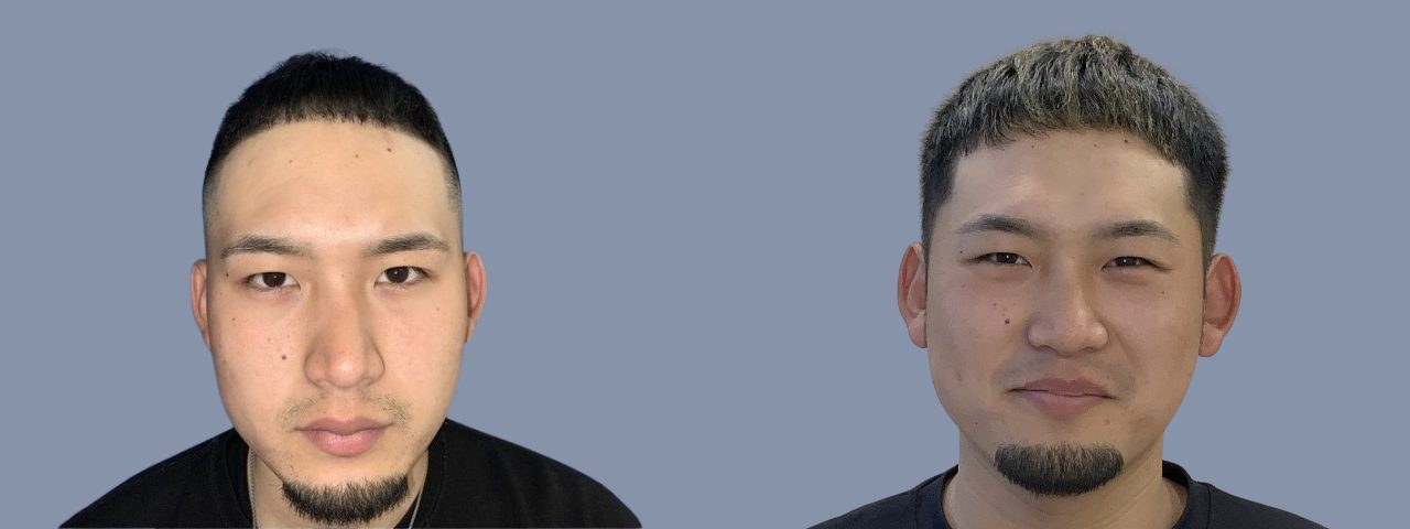 生え際-20代-1000～2000株-男性-刈り上げる自毛植毛i-Direct