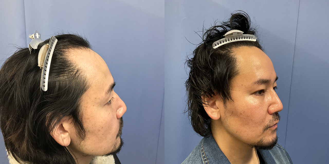【新宿院/30代/男性/i-Direct/1200G/生え際・前頭部】-2
