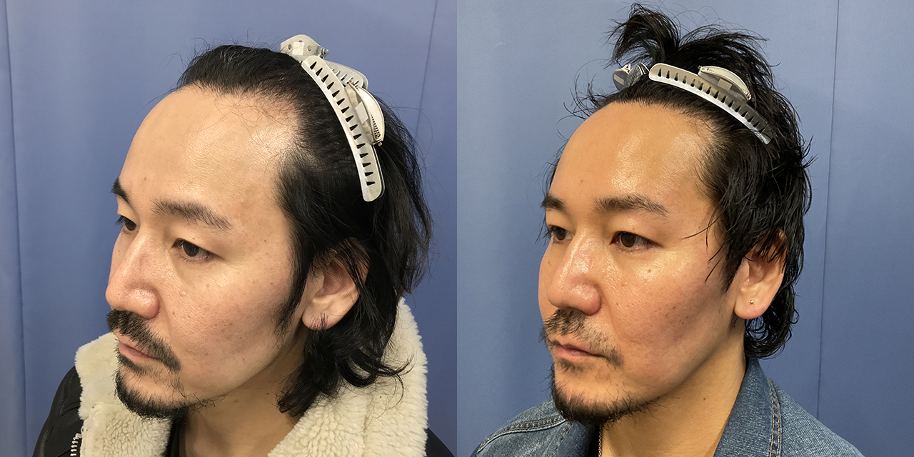 【新宿院/30代/男性/i-Direct/1200G/生え際・前頭部】-3